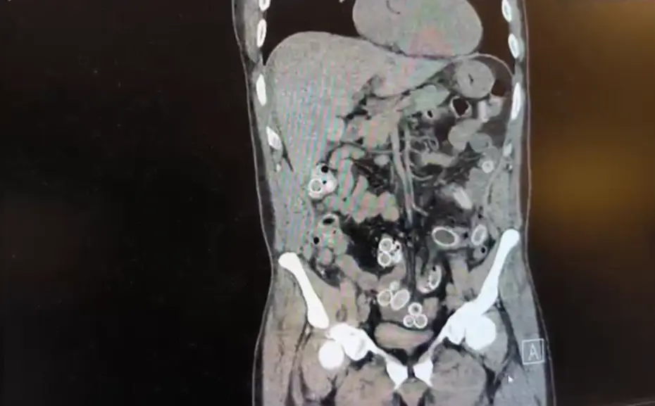 Ağrıyla hastaneye gitti, hepsini midesine gizlemiş. Tutuklandı