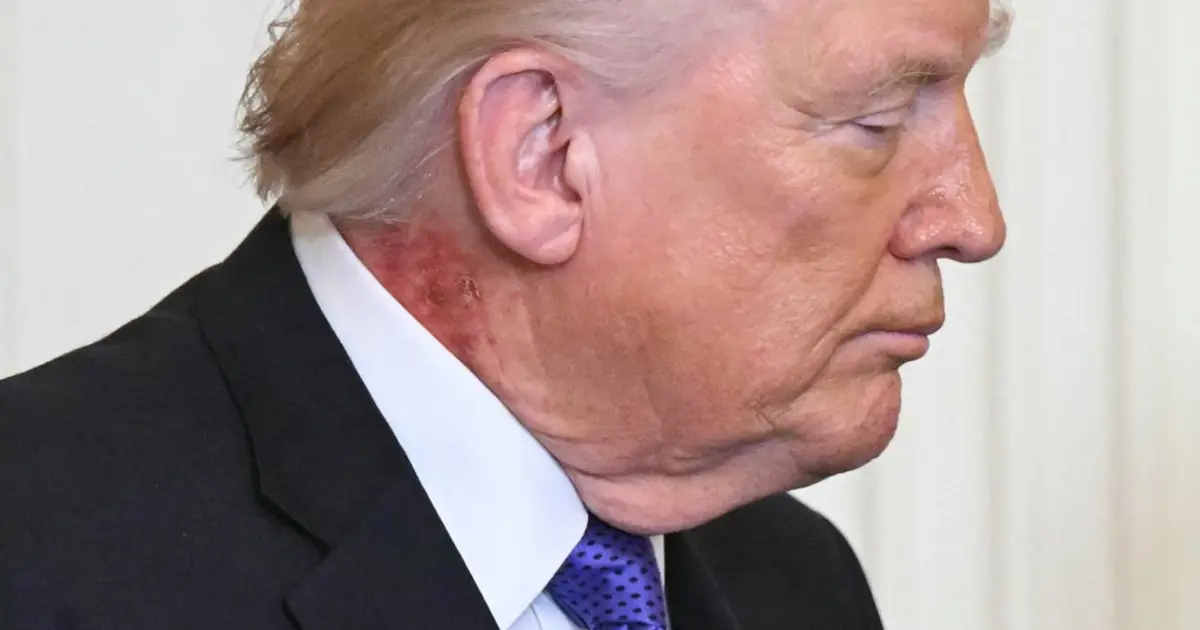 Trump'ın boynundaki kırmızı leke gündem oldu. Beyaz Saray'dan açıklama var.