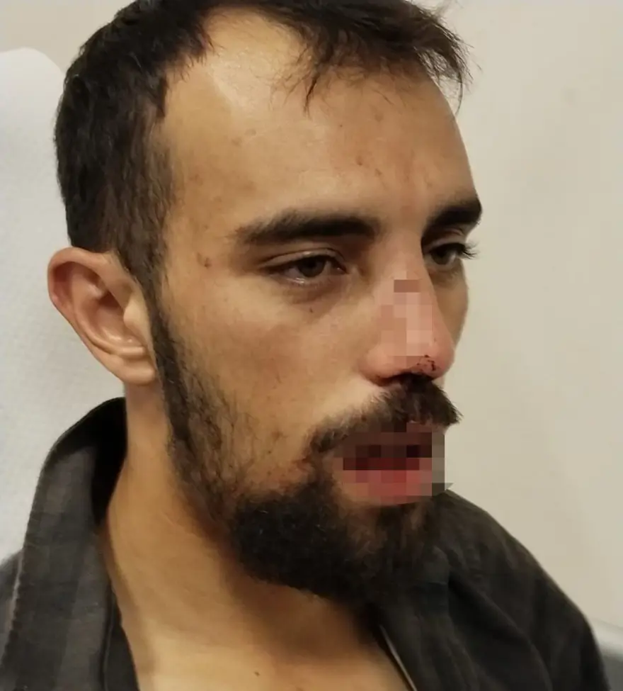 Veteriner hekime saldırı iddiası (Çenesinde ve vücudundakırıklar var) 1 Veteriner hekime saldırı iddiası (Çenesinde ve vücudundakırıklar var) 1