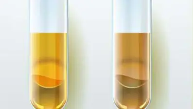 İdrar rengi kanser veya enfeksiyon habercisi de olabilir