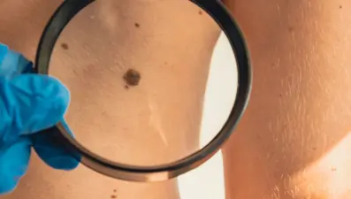 Cilt kanserinin 7 sinsi belirtisi: Uzmanlar ''10 dakika bile tehlikeli'' diyor