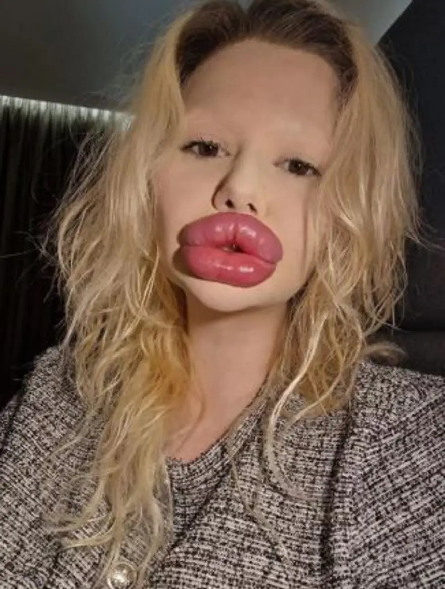 Dünyanın en büyük dudaklı kadını: Sağlık çalışanları onu tedavi etmeyi reddediyor 