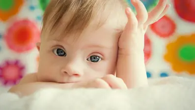 “Down sendromuna 1 yaşından önce müdahale edilmeli"