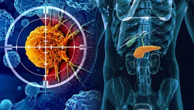 Pankreas kanserinde "olağanüstü aşı" keşfedildi: Ömrü uzatıyor