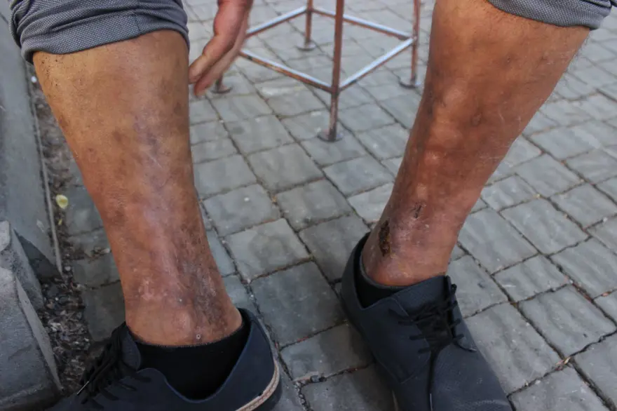 Sülük tedavisi hayatını kararttı! 2 aydır işe gidemiyor, yürümekte güçlük çekiyor 1