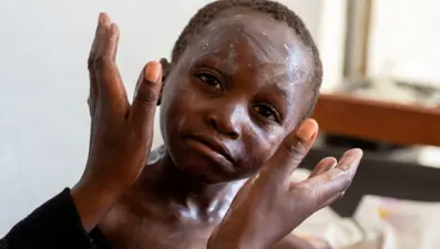 Batı'nın söz verdiği maymun çiçeği aşıları Afrika ülkelerine ulaşmadı