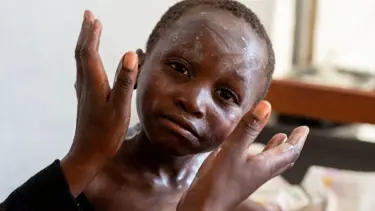 Batı'nın söz verdiği maymun çiçeği aşıları Afrika ülkelerine ulaşmadı