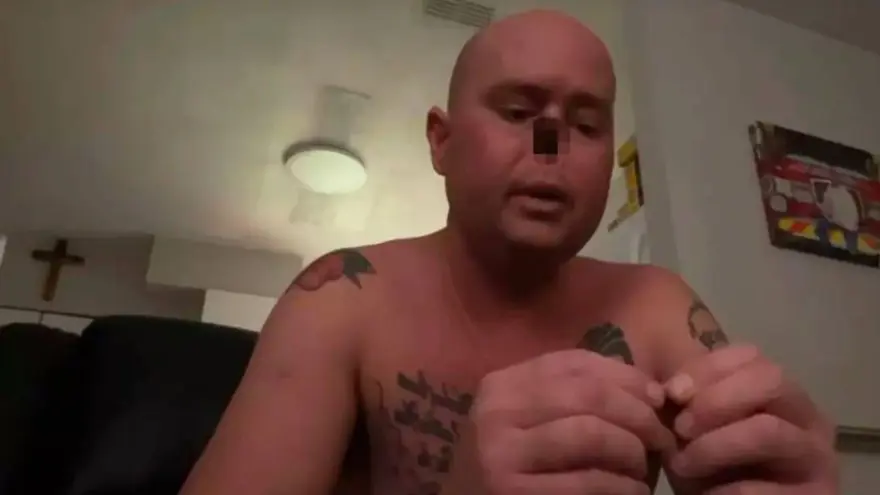 Milyonda 2 kişide görülüyor: Grip oldu, burnunu kaybetti 1