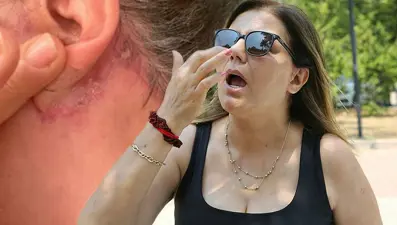 Antalya'da estetik sonrası burun kemikleri eriyip düştü