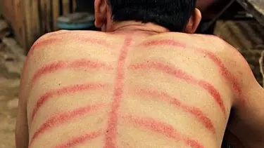 Endonezya'da soğuk algınlığına bozuk paralı tedavi (Kerokan nedir?)