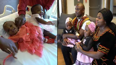 Kamerunlu siyam ikizleri İstanbul’da ayrıldı: Operasyon 27 saat sürdü