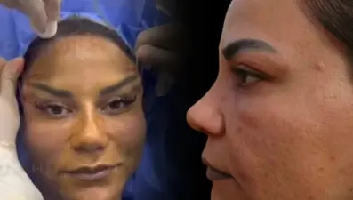 220 bin liraya estetik oldu, hayatı kabusa döndü!