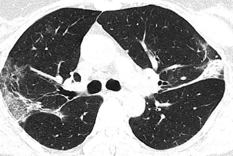44yaşında corona virüsten hayatını kaybeden kişinin  akciğer röntgen filmleri virüsün verdiği zararıortaya çıkardı 5