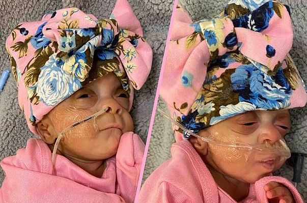 “Mucize” prematüre ikizler ABD’de dünyaya geldi