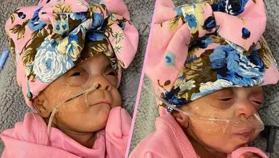 “Mucize” prematüre ikizler ABD’de dünyaya geldi