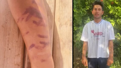 Lazer epilasyon yaptırdığı merkezde kabus yaşadı: “Ben yandım başkaları yanmasın"