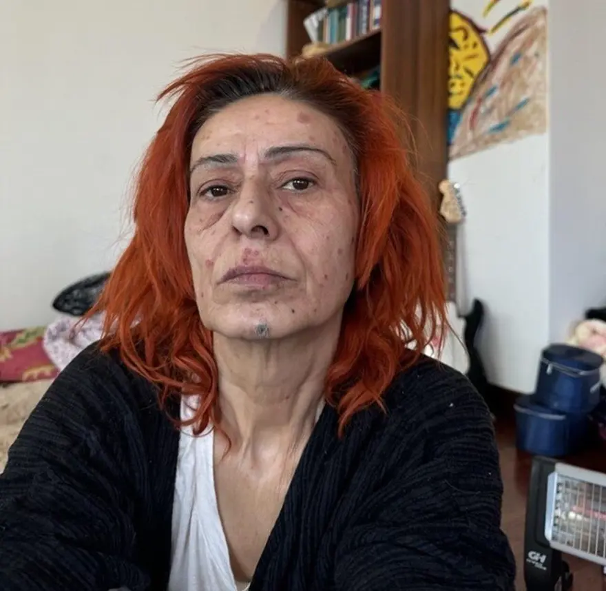 Yıldız Tilbe yüzündeki renkli beneklerle konser verdi 