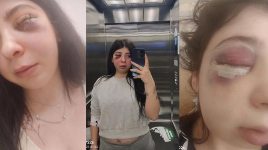 Sokak ortasında önce sözlü taciz sonra saldırı: Damla üç ay sadecesıvıyla beslenecek Sokak ortasında önce sözlü taciz sonra saldırı: Damla üç ay sadecesıvıyla beslenecek