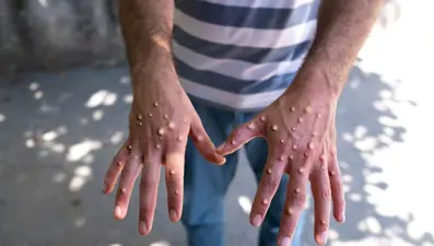 M-Çiçeği Avrupa'da yayılıyor: Kosova'da ilk vaka