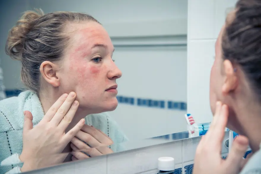 Dermatolog açıkladı: Hava soğuduğunda cildiniz neden kızarır? 4 Dermatolog açıkladı: Hava soğuduğunda cildiniz neden kızarır? 4