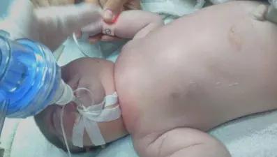 Doğum sırasında bebeğin köprücük kemiğinin kırıldığı iddiası