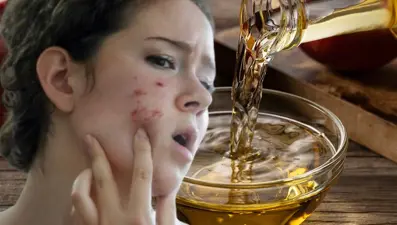 Cilt lekelerini açan doğal aydınlatıcı: Geceler suyla karıştırıp sürmek yetiyor