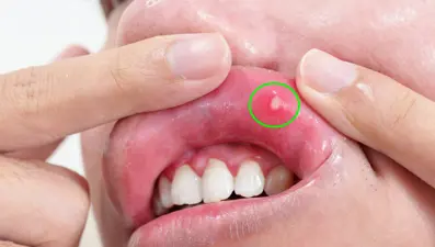 5 belirgin B vitamini eksikliği belirtisi: Vücut için hayati önemi var