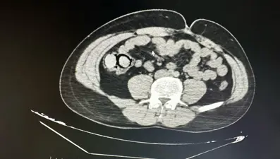 Midelerinden 10 parça uyuşturucu çıktı! 2 kişi tutuklandı