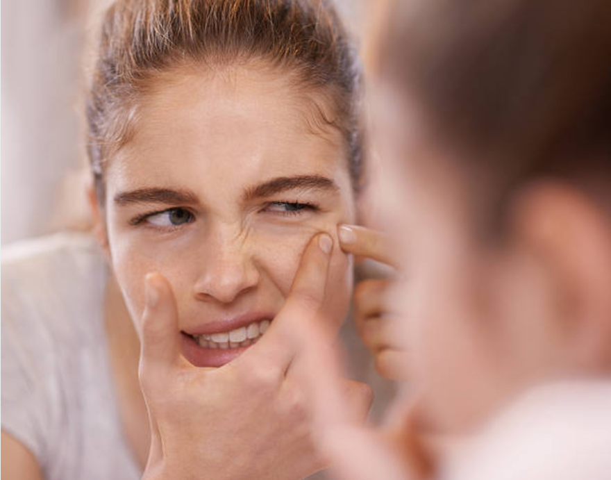 AKNE NASIL TEDAVİ EDİLİR? 5