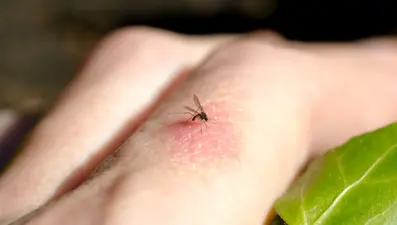 Uzmanlardan uyarı! Sivrisinek ısırığına bunları sürmeyin