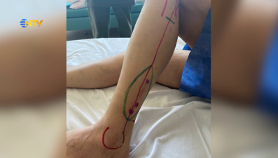 Bacak kemiğinden çene yaptılar (NTV ÖZEL)