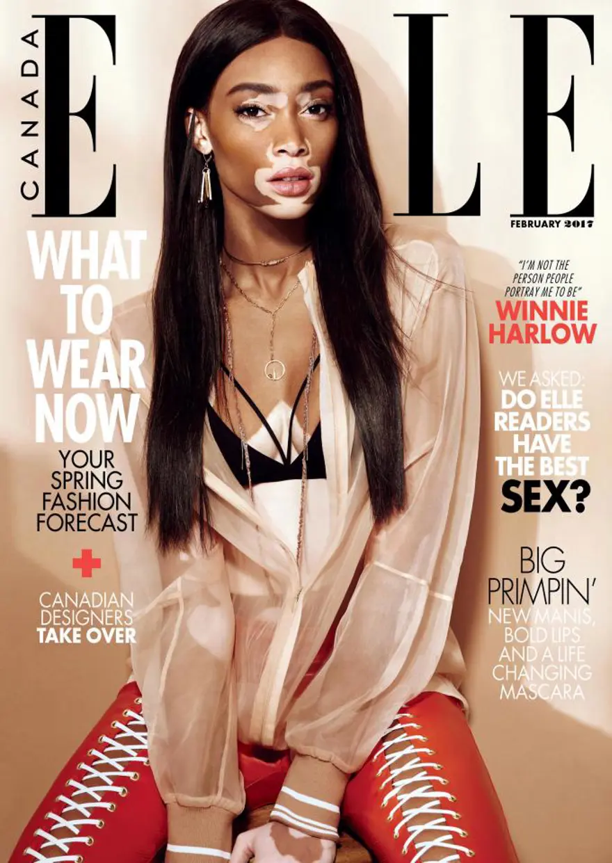Vitiligolu model Winnie Harlow: Sizin gibi beynim ve iskeletim var 4
