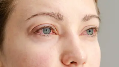 Göz rengi değiştirip kör oluyorlar