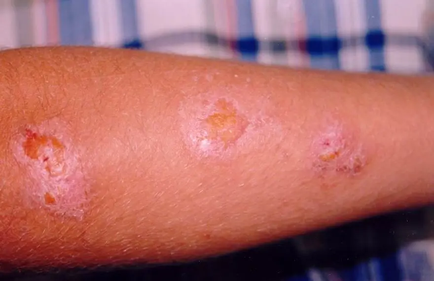 "BULAŞTIRDIĞI HASTALIKLAR DAHA GEÇ ATLATILIYOR" 4