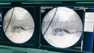 13 aylık bebeğin böbreğinden 5 santimetrelik taş çıktı