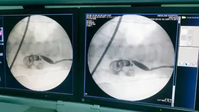 13 aylık bebeğin böbreğinden 5 santimetrelik taş çıktı