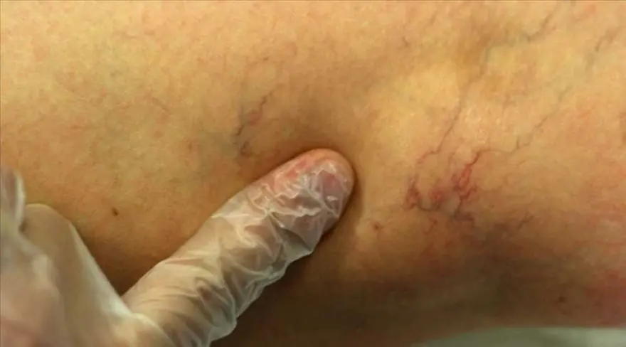 VARİS HASTALARI ORUÇLUYKEN UZUN SÜRE AYAKTA DURMAK SAKINCALI MI? 2