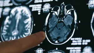 Alzheimer hastaları için gerçek bir tedavi sunan ilk ilaç: Lecanemab nedir? Lecanemab'ın yan etkileri nelerdir?