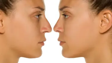 Rinoplasti (burun estetiği) ameliyatında dikkat edilmesi gerekenler