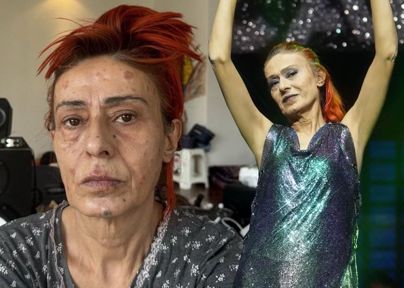 Yıldız Tilbe'nin yüzünde yanıklar oluşmuştu: Olayın perde arkasını anlattı