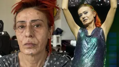 Yıldız Tilbe'nin yüzünde yanıklar oluşmuştu: Olayın perde arkasını anlattı