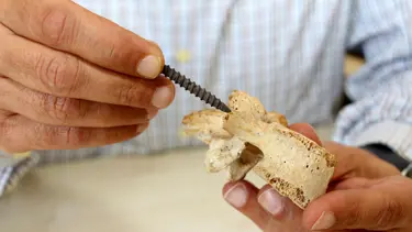 3 boyutlu metal yazıcıda omurga vidası üretildi