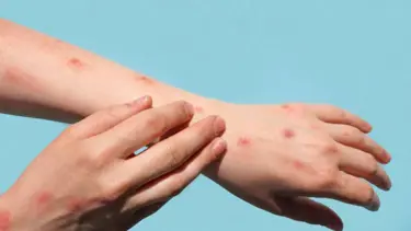 Vaskülit nedir, belirtileri nelerdir? Vaskülit tedavisi nasıl yapılır?