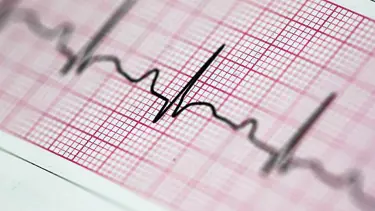 EKG nedir, nasıl çekilir? EKG neden çekilir?