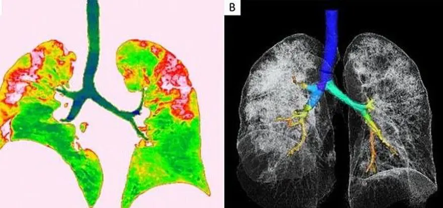 44yaşında corona virüsten hayatını kaybeden kişinin  akciğer röntgen filmleri virüsün verdiği zararıortaya çıkardı 4