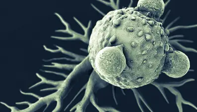 Tiroit kanserine yakarak müdahale (Microwave ablasyon nasıl etki ediyor?)