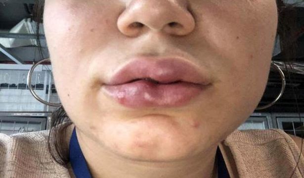 “Dudak dolgusunda doktor ihmali” iddiasıyla 250 bin liralık dava açtı