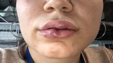 “Dudak dolgusunda doktor ihmali” iddiasıyla 250 bin liralık dava açtı