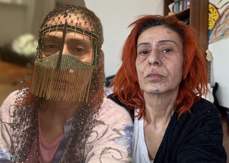 Yüzünde yanıklar oluşmuştu: Yıldız Tilbe maskeyle poz verdi
