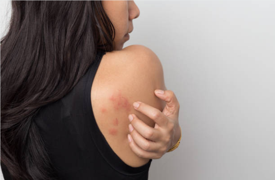 KURDEŞEN BELİRTİLERİ NELERDİR? 9